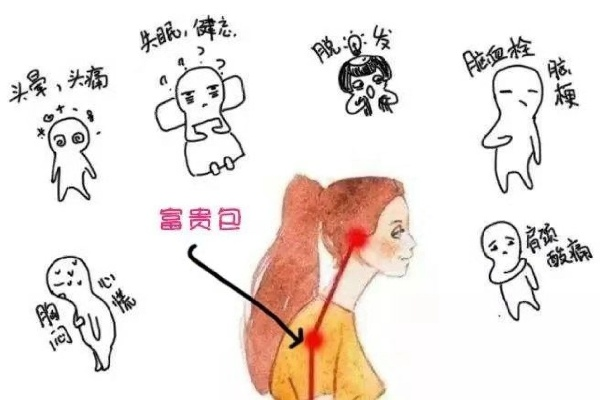 什么坐姿导致富贵包？了解这些，预防颈椎问题